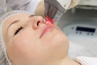Facial rejuvenation procedure with fractional laser