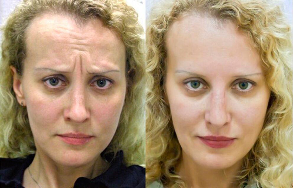 before and after using the massage for rejuvenation ltza photo 1