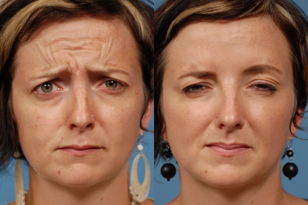 before and after using the massage for rejuvenation ltza photo 2