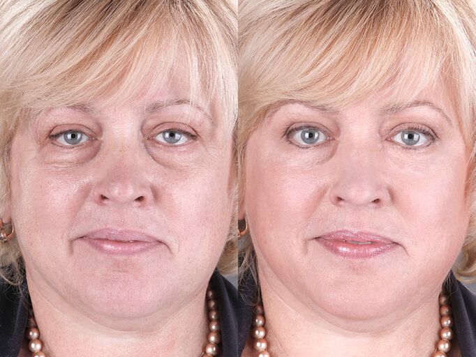 before and after using the massage for rejuvenation ltza photo 3