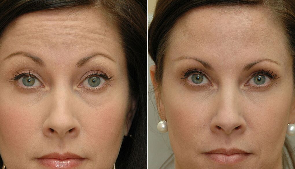 before and after using the massage for rejuvenation ltza photo 4