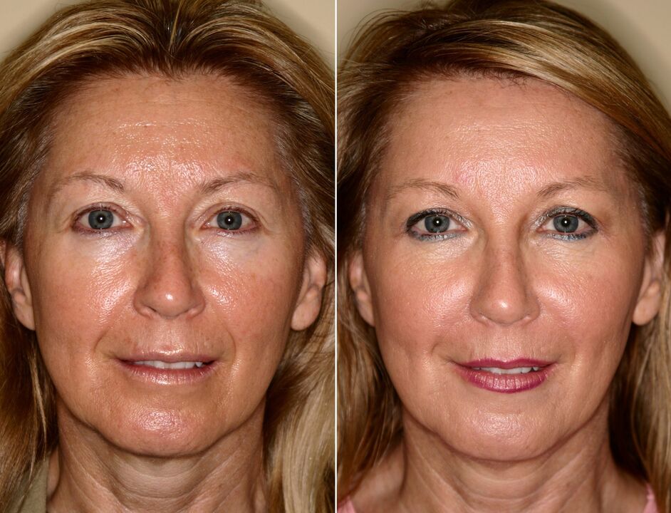 before and after using the massage for rejuvenation ltza photo 5