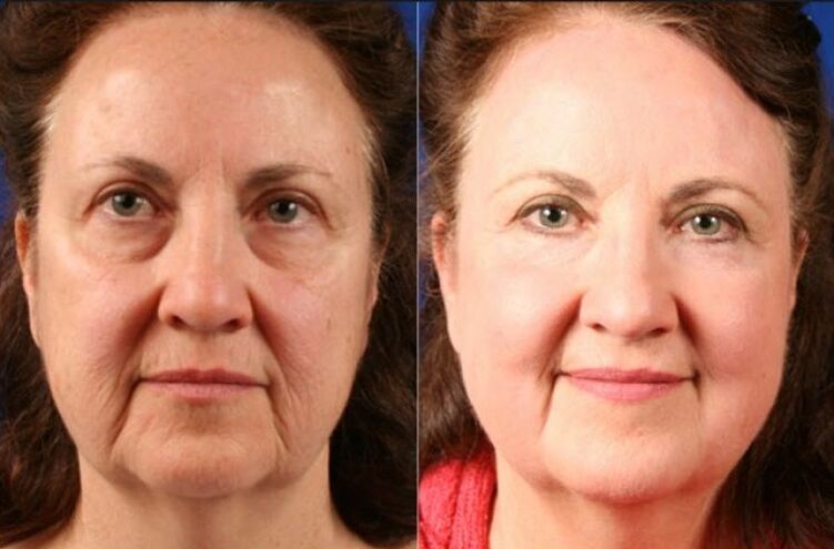 before and after using the massage for rejuvenation ltza photo 6