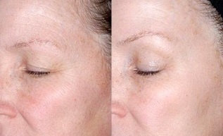 rejuvenate the skin around the eyes before and after photos