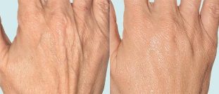 Hand skin before and after fractional treatment