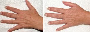 The result of the removal of age spots on the hands