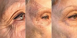 photos before and after skin rejuvenation in plasma